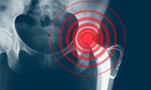 شیوع بیش از ۴۱ درصدی پوکی استخوان در افراد بالای ۶۰ سال